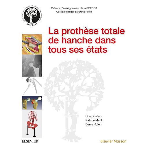 La prothèse totale de hanche dans tous ses états